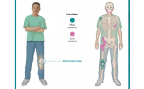 Os sintomas do osteossarcoma variam segundo a área afetada. É comum junto ao joelho (fêmur ou tíbia), mas pode surgir no ombro, bacia ou crânio.